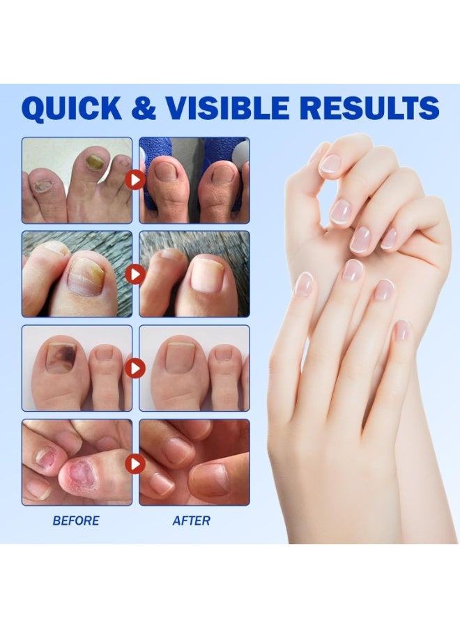 لصقات علاج فطريات الأظافر - حل فعال للعناية بأظافر قدم صحية وقوية. سهلة الاستخدام، سريعة المفعول، ونتائج تدوم طويلاً. - Image 2